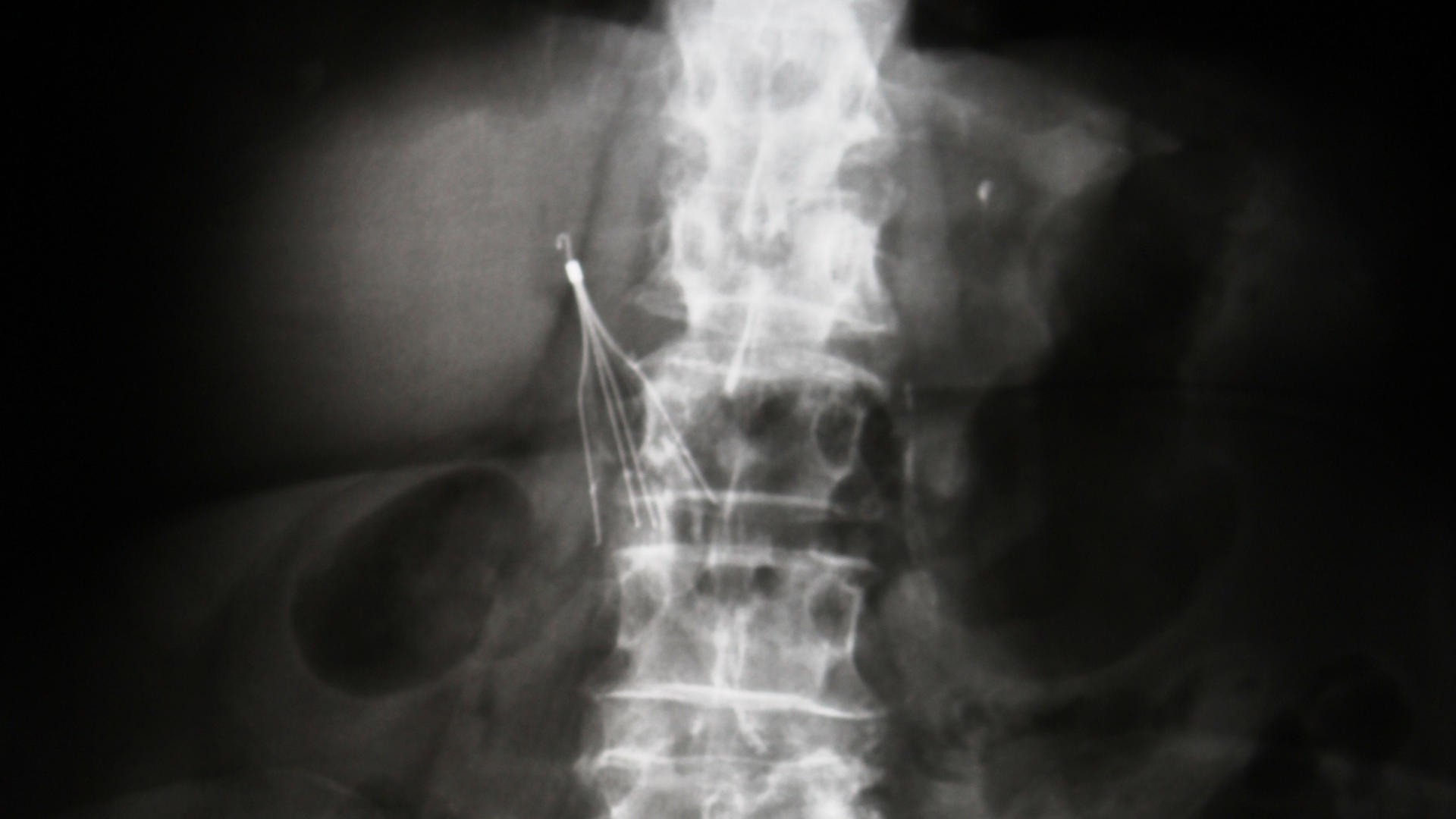 Monocyte in a blood film