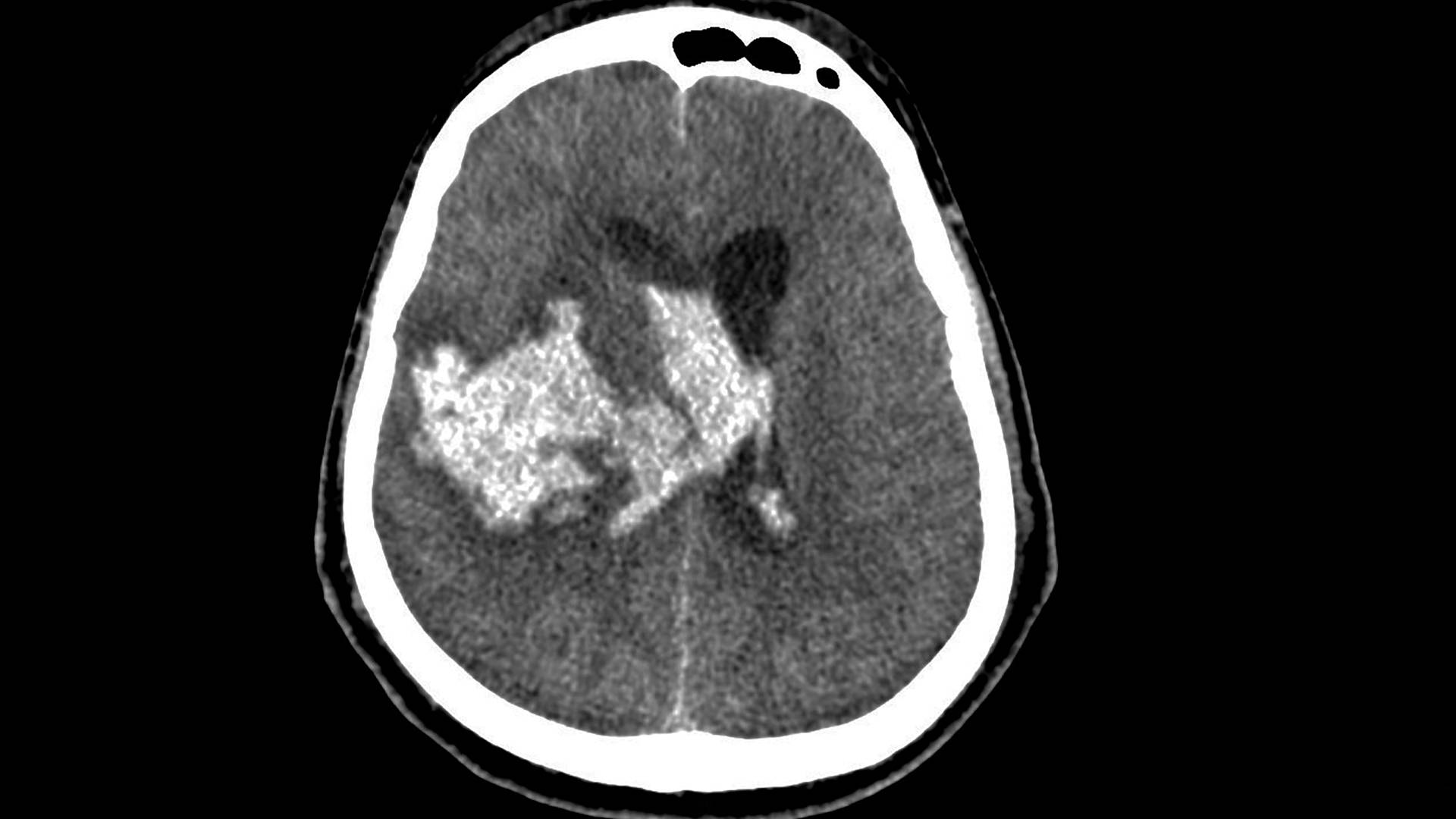 CT brain showing a large intra cerebral haemorrhage